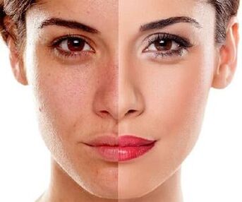 la pelle del viso cambia dopo il peeling laser