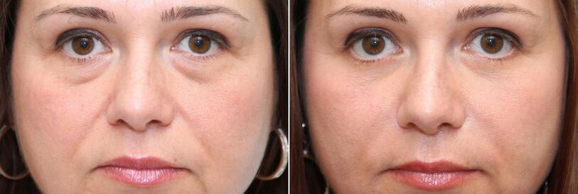 Prima e dopo la blefaroplastica rimozione del corpo adiposo sotto gli occhi e rassodamento della pelle