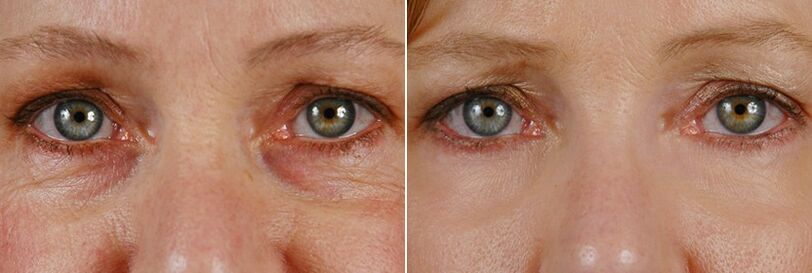 Prima e dopo la chirurgia laser ringiovanimento della pelle intorno agli occhi
